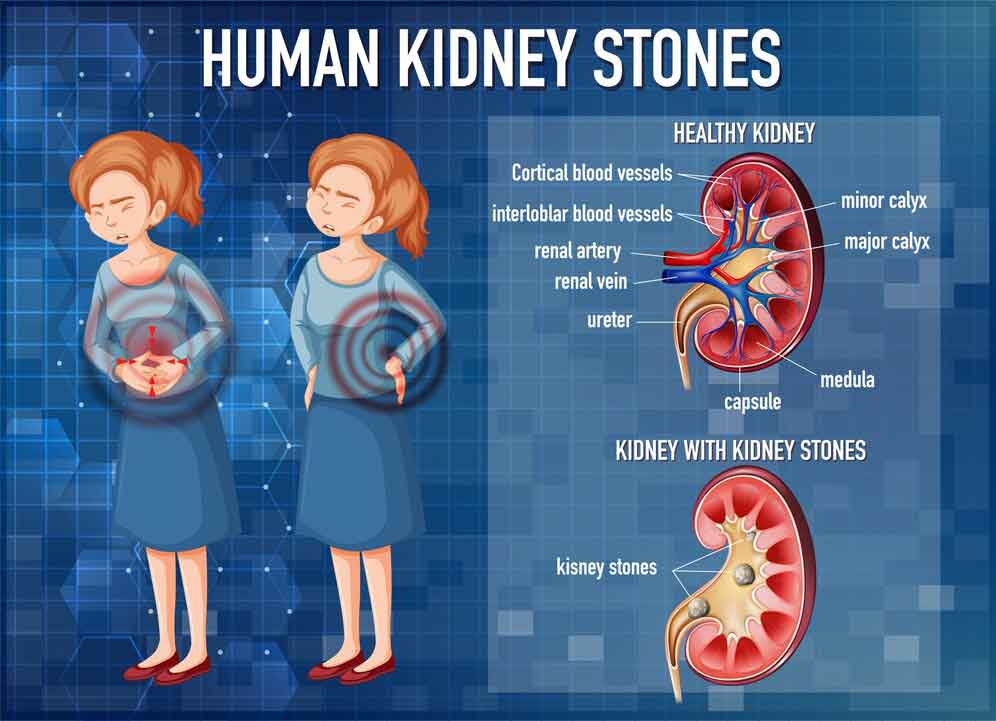 kidney-infection-symptoms-and-treatment-in-urgent-care-health-care