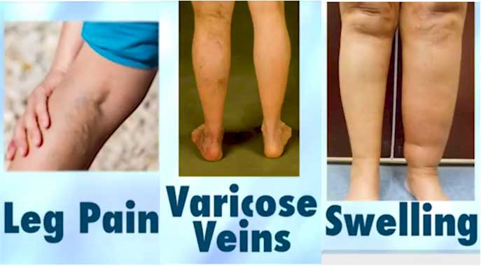 How to Identify Varicose Veins?