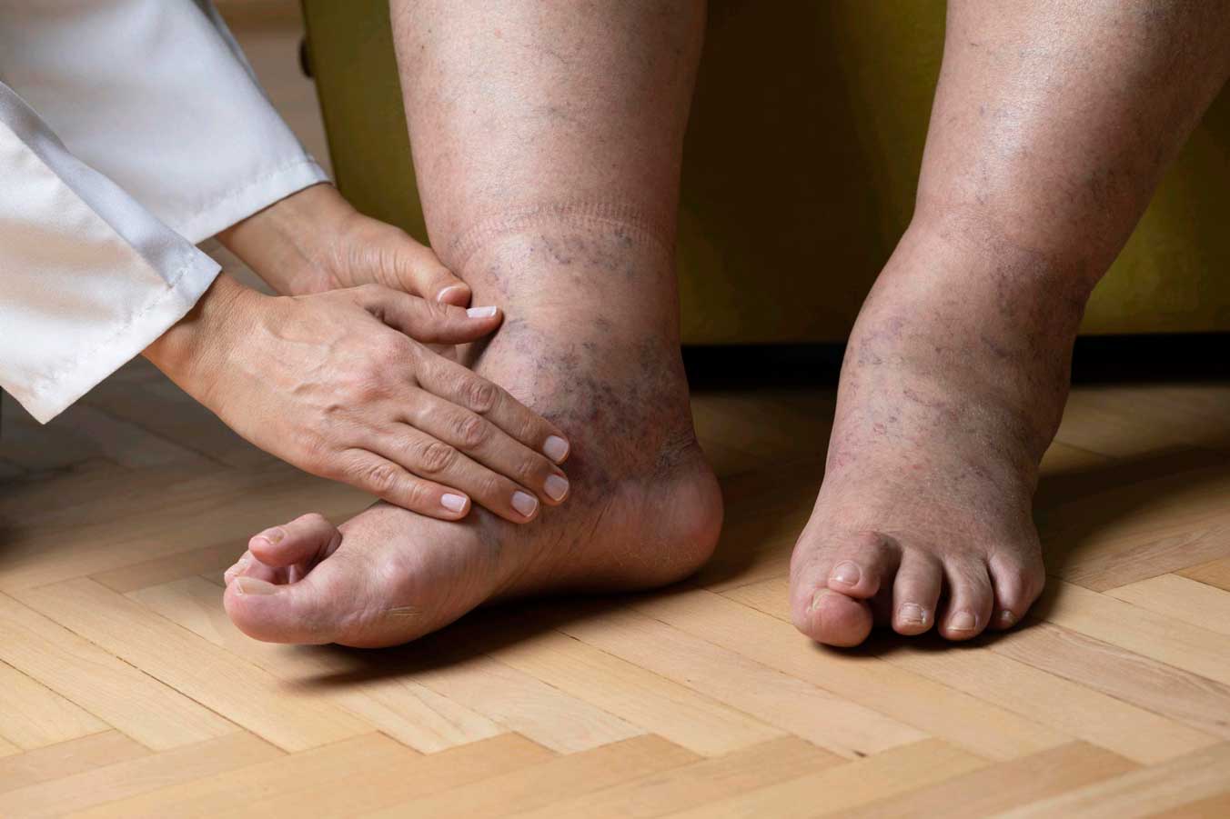 Diabetic Neuropathy : Causes, Symptoms, Prevention, Treatment | Texas ...