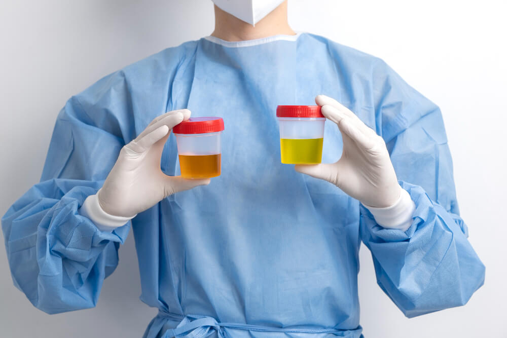 Unveiling Your Health What a Urinalysis Reveals in a Simple Pee Test